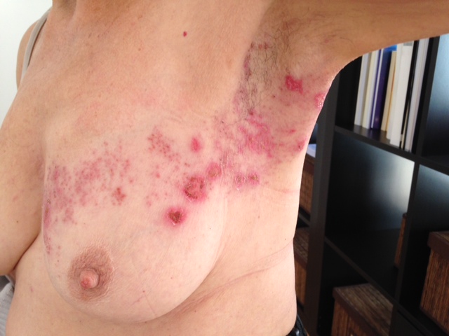 Shingles Pictures: Shingles Rash, Other Symptoms of ...